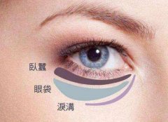 了解淚溝、臥蠶和眼袋的區(qū)別后再選擇手術方式