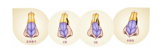 歪鼻矯正手術(shù)的創(chuàng)傷大嗎？鼻子有點(diǎn)兒歪