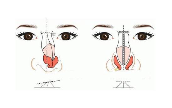 歪鼻矯正術(shù)的恢復(fù)期