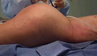 假體豐臀適合哪類人群？