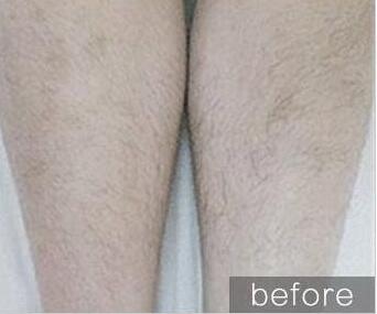 冰點脫毛應該間隔多久呢?