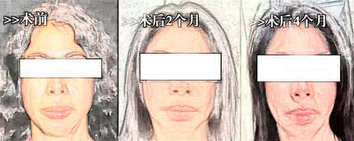 上了30歲打玻尿酸皮膚容易變松弛嗎?