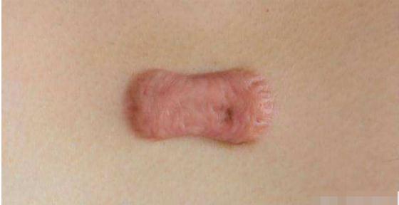 瘢痕疙瘩調(diào)節(jié)：疤痕體質(zhì)打耳洞容易長疙瘩？