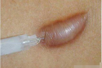 瘢痕疙瘩的調(diào)節(jié)方法