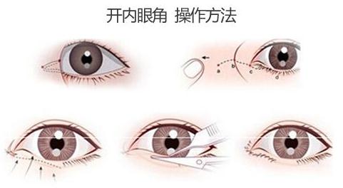 不是所有人都是適合開眼角手術(shù)！