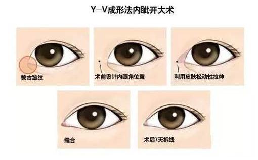 不是所有人都是適合開眼角手術(shù)！