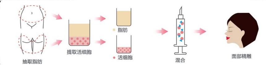 面部脂肪填充過量，按壓和吸脂可以解決這問題