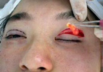 做完雙眼皮全切后會(huì)不會(huì)出現(xiàn)腫脹現(xiàn)象?