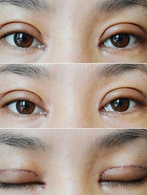 做完雙眼皮全切后腫脹現(xiàn)象會(huì)持續(xù)多久?
