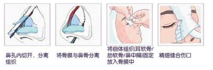 想要隆鼻，自體耳軟骨和肋軟骨哪一個更好？