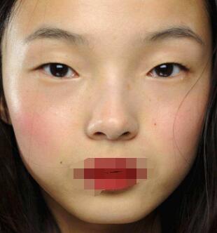 眼距過寬不符合美學(xué)標(biāo)準(zhǔn)