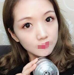 全切雙眼皮拆線之后的注意事項