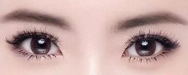 全切雙眼皮拆線之后的注意事項