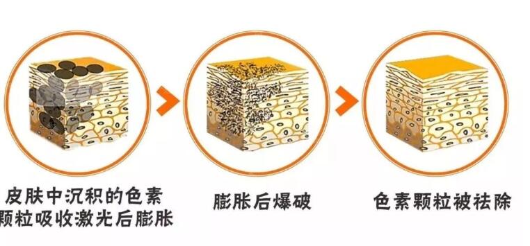 激光祛斑的的原理介紹