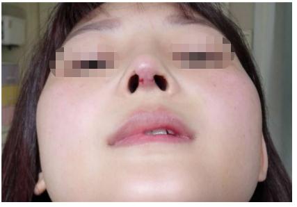 鼻部手術手術后多長時間可以拆線?