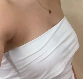 抽脂豐胸手術(shù)后第3天