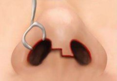 做綜合隆鼻手術(shù)的恢復期大概是多長時間？