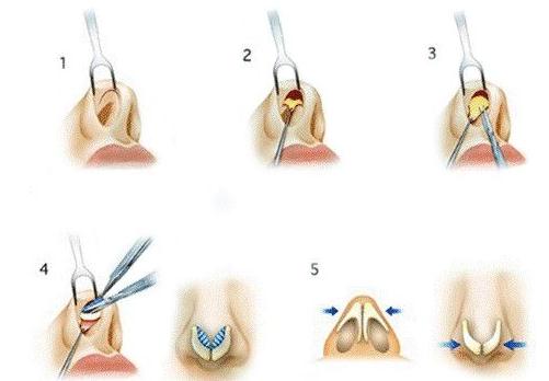 隆鼻手術(shù)鼻部手術(shù)怎么樣？