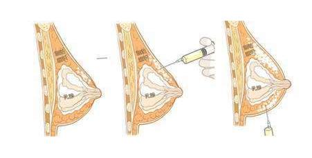 自體脂肪移植乳房手術(shù)原理