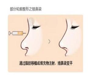 自體脂肪隆鼻的缺點(diǎn)