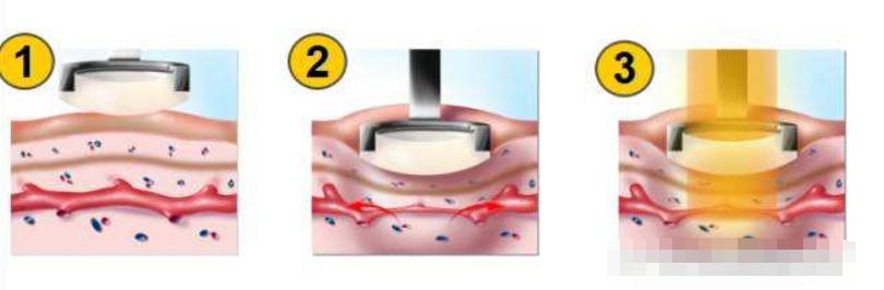 用激光去除紅血絲沒問題嗎？