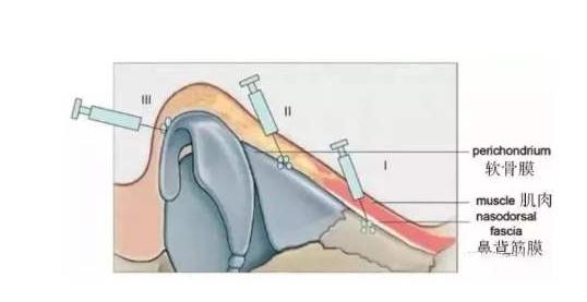 延長(zhǎng)鼻小柱的注意事項(xiàng)