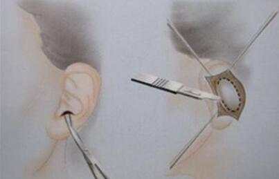 自體耳軟骨隆鼻術(shù)