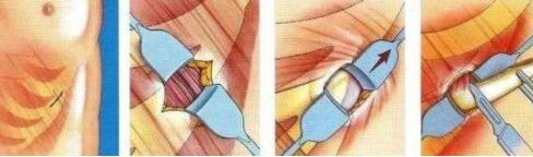 肋軟骨隆鼻術(shù)：