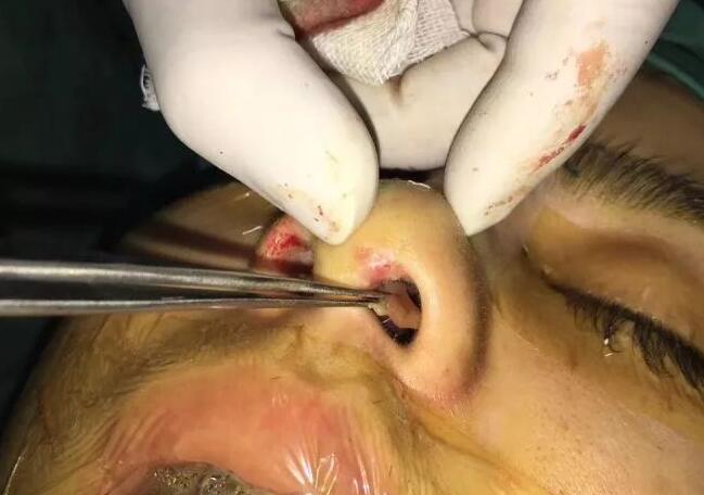 鼻部手術可以維持多久？