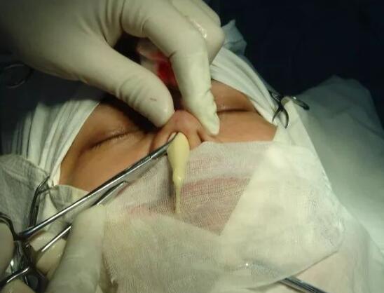 綜合性鼻整形術(shù)后腫脹會持續(xù)多久?