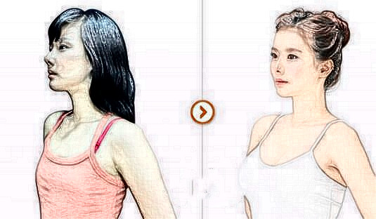 自體脂肪移植乳房果能維持多久？