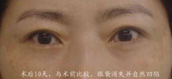 激光祛眼袋的果怎么樣呢？