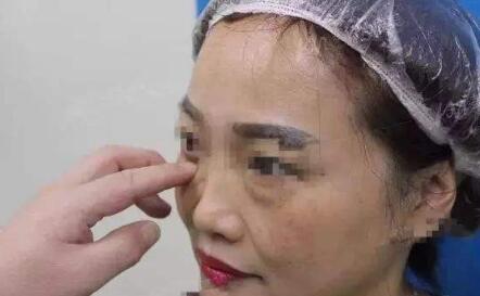 激光祛眼袋多少錢?