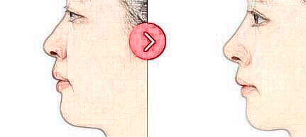 自體脂肪隆鼻的果能維持多久？