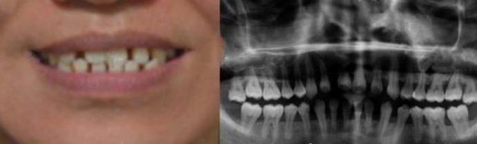 牙齒稀疏給我?guī)淼耐催@輩子都忘不掉！矯正案例