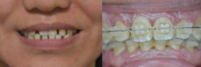 牙齒矯正術(shù)后一個星期