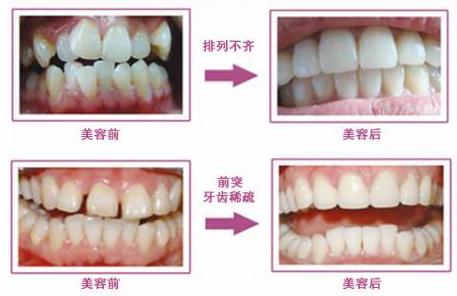 牙齒矯正半個月