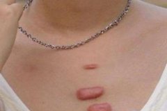 胸前有疤痕疙瘩應該怎么辦？要怎樣調(diào)節(jié)？