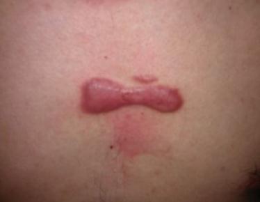 胸前有疤痕疙瘩應(yīng)該怎么辦？