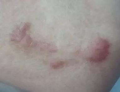 胸前有疤痕疙瘩應(yīng)該怎么辦？