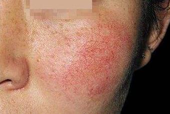 激光去紅血絲沒問題嗎？真的一點(diǎn)都不喜歡“高原