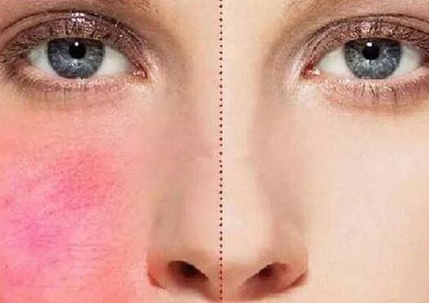 紅血絲是怎么引起的？