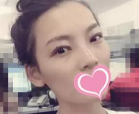 到長沙愛**做了扇形雙眼皮術(shù)后第23天