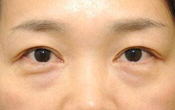 韓式微創(chuàng)手術(shù)去眼袋優(yōu)勢