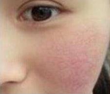 激光去紅血絲怎么樣？