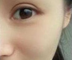 激光去紅血絲怎么樣？