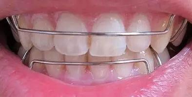 牙齒矯正三個月