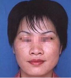 雀斑到底可以完全祛除嗎?