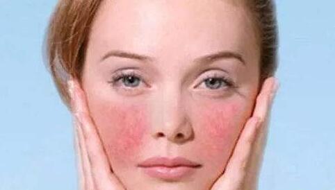 激光去紅血絲沒問題嗎？一點(diǎn)都不喜歡“高原紅”