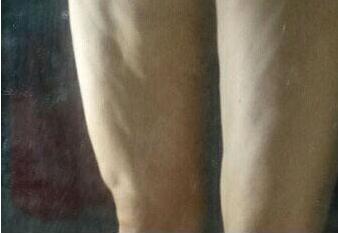 吸脂后出現(xiàn)凹凸不平怎么辦?